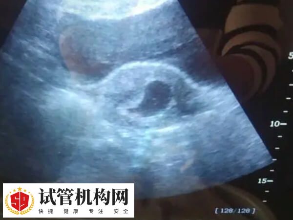 胚胎移植19天B超不可见胎心胎芽