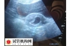 移植19天胚胎发育怎么样